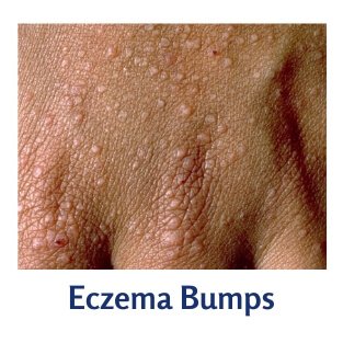 eczema bumps