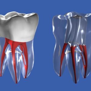 How Many Chances of Getting Infections After Root Canal Treatment?